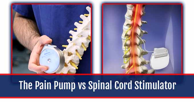 Pain Pump vs Spinal Cord Stimulator